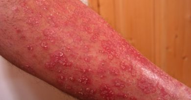 Jaké kožní nemoci mohou být symptomem něčeho vážnějšího?