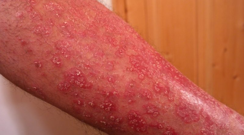 Jaké kožní nemoci mohou být symptomem něčeho vážnějšího?
