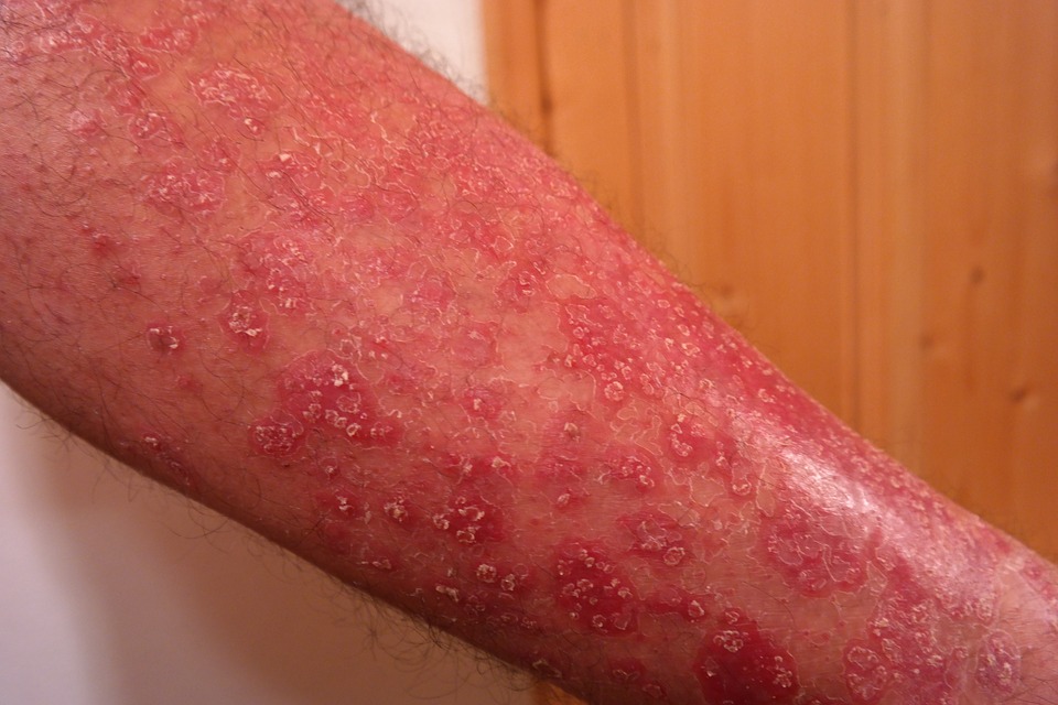 Jaké kožní nemoci mohou být symptomem něčeho vážnějšího?